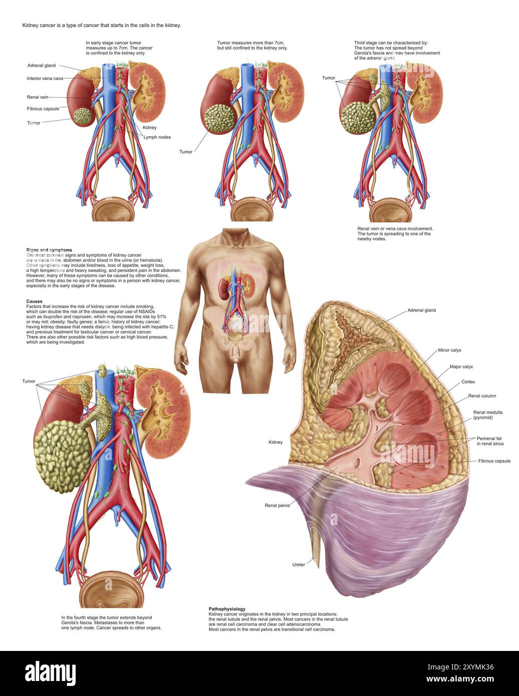 Medical chart showing the signs and symptoms of kidney cancer Stock Photo