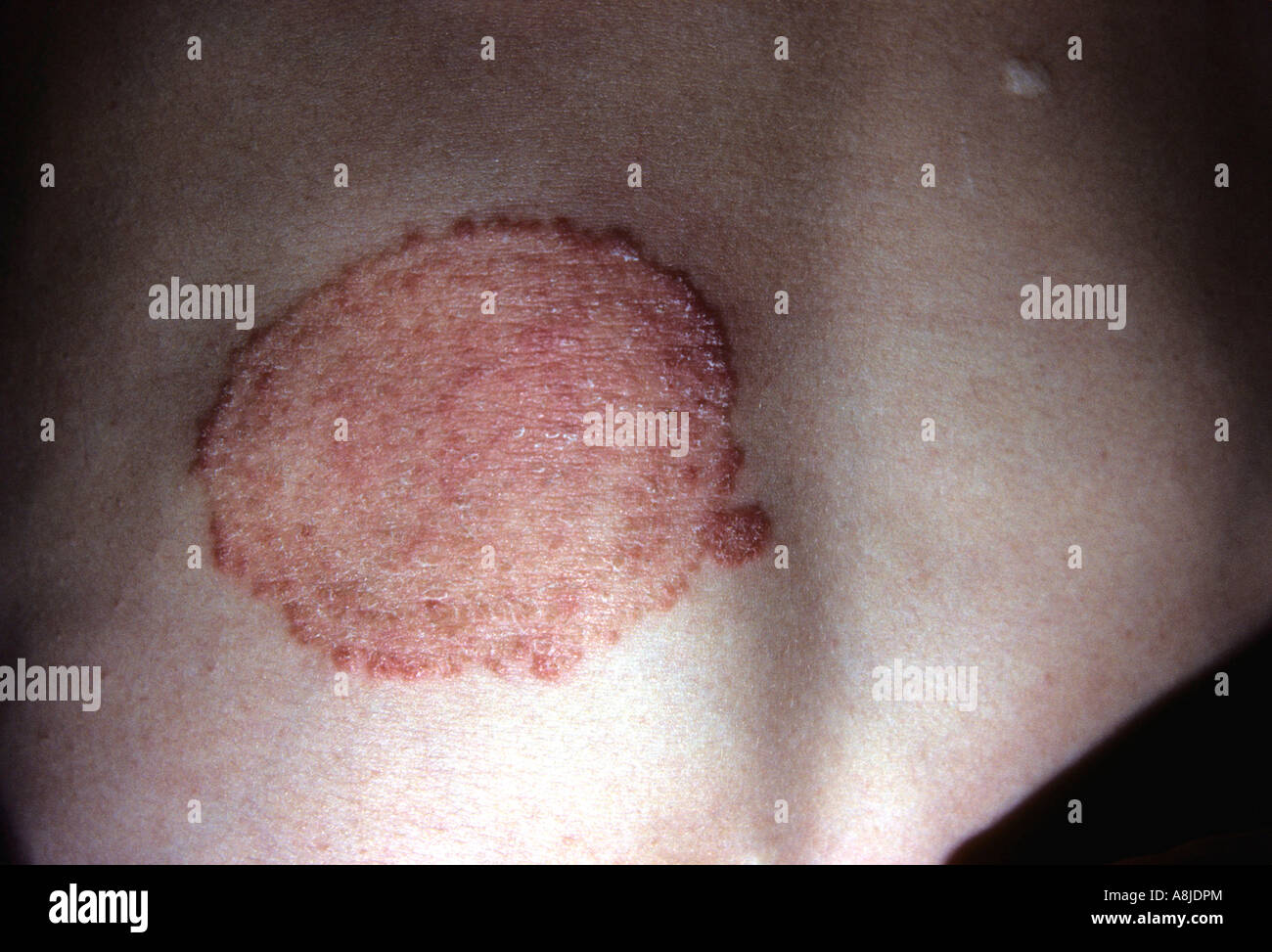 Tinea corporis fungal infection. Stock Photo