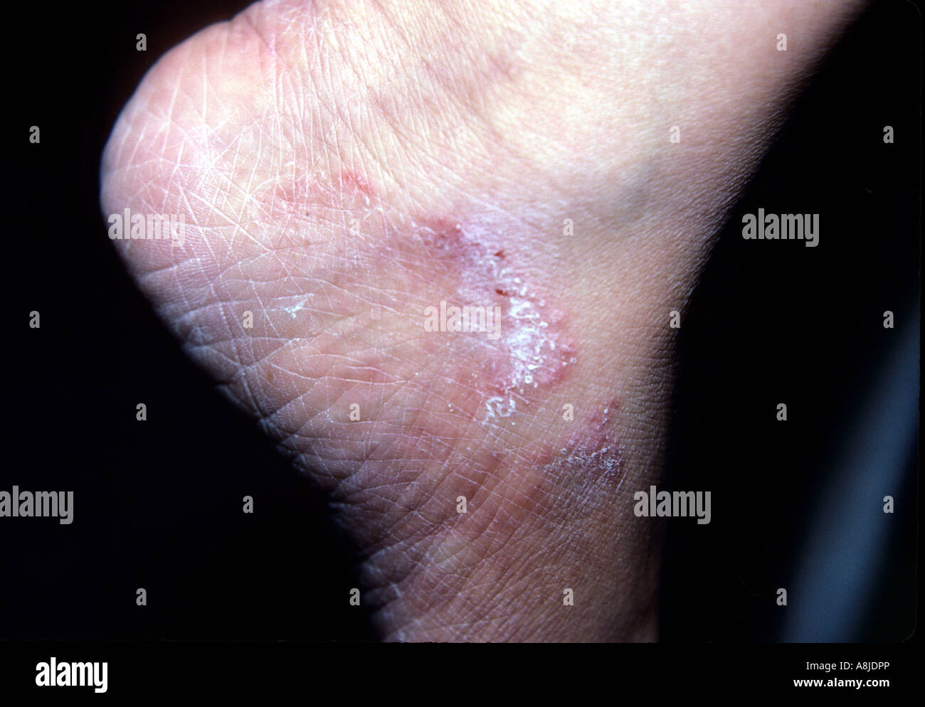 Fungal infection rash (tinea) on patient's ankle. Stock Photo