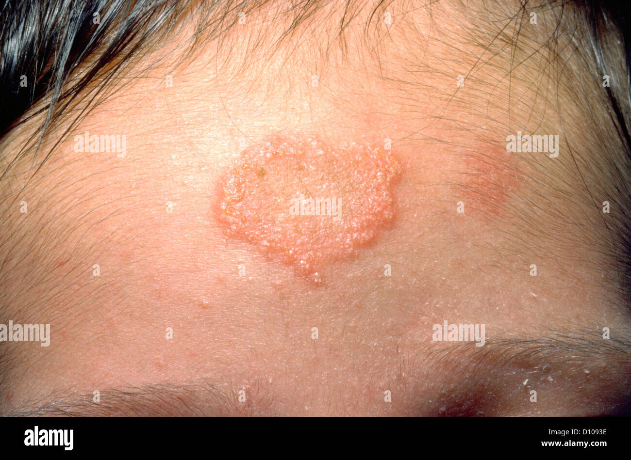 FUNGAL RASH ON THE FOREHEAD Stock Photo