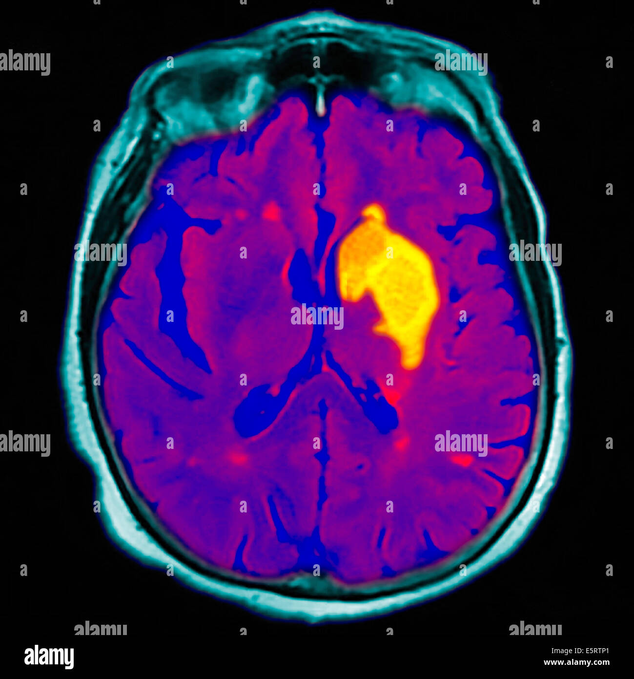 Coloured magnetic resonance imaging (MRI) scan and CT of an axial section through the brain of patient, showing the damage Stock Photo