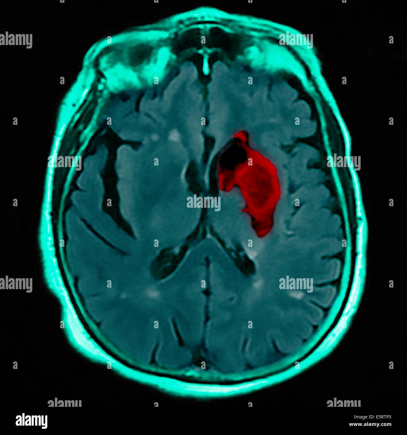 Coloured magnetic resonance imaging (MRI) scan and CT of an axial section through the brain of patient, showing the damage Stock Photo