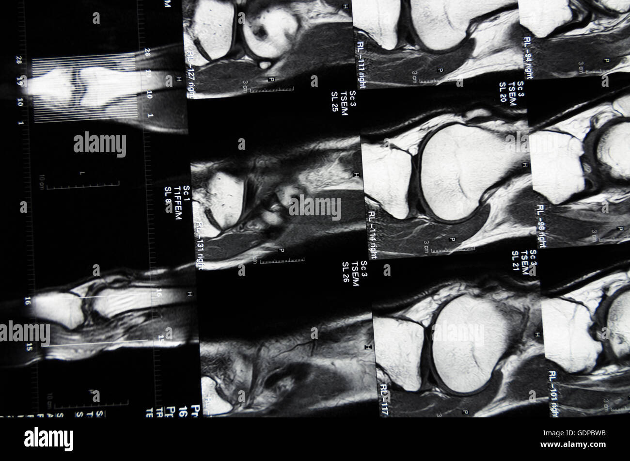 : Magnetic Resonance Imaging ( MRI ) : cross-sectional images of a knee, , , Stock Photo