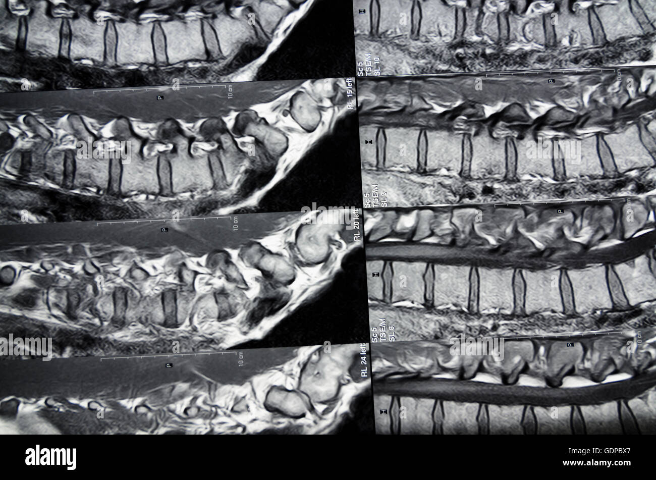 : Magnetic Resonance Imaging ( MRI ) : cross-sectional images of the lumbar spine, , , Stock Photo