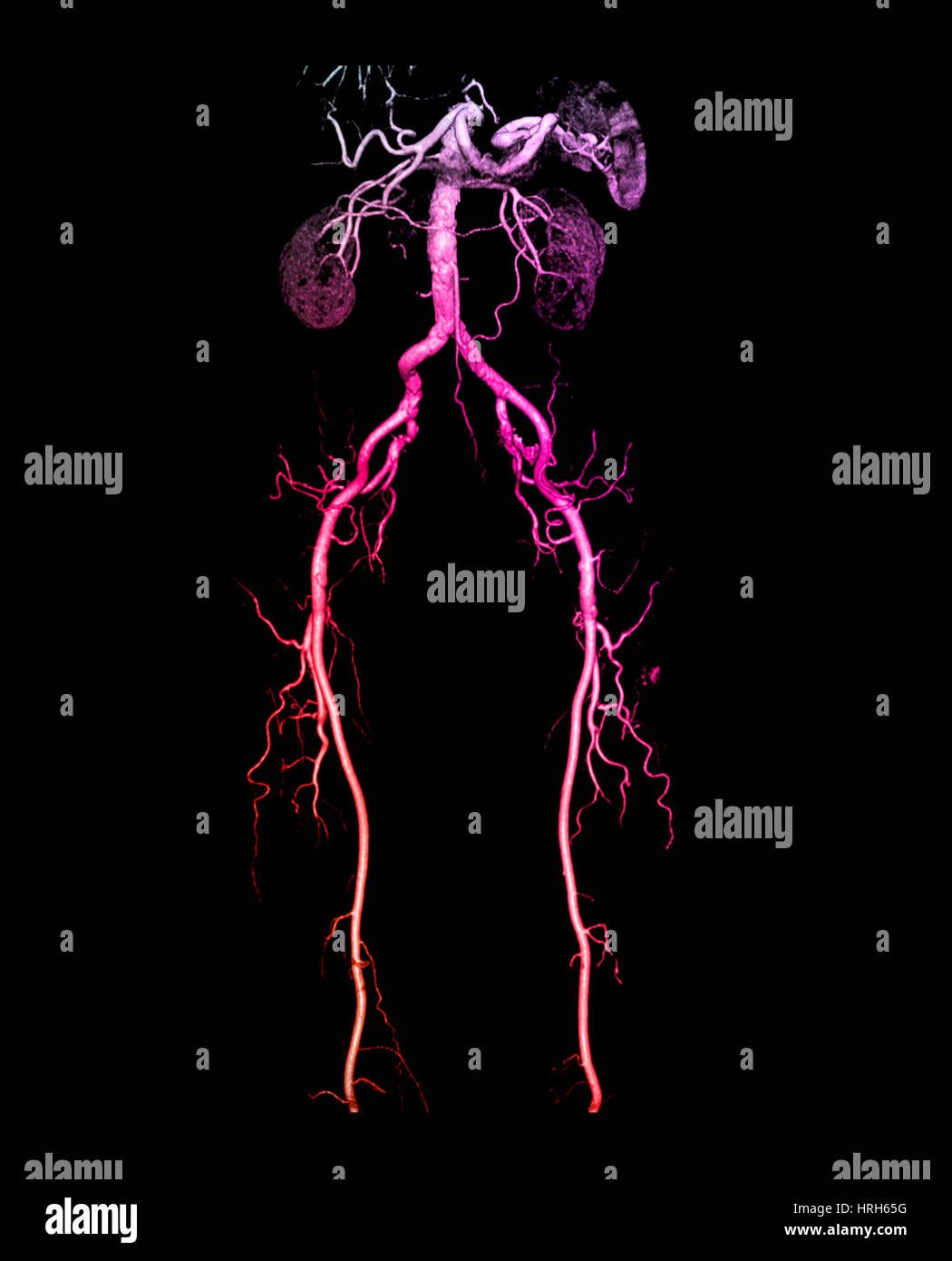 CT Angiogram of Abdomen and Legs Stock Photo