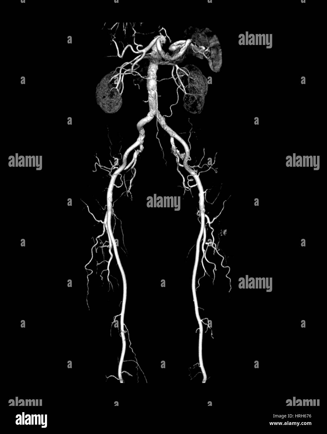 CT Angiogram of Abdomen and Legs Stock Photo