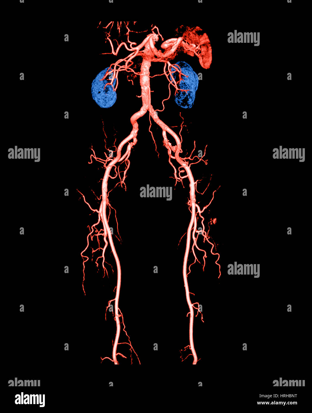 CT Angiogram of Abdomen and Legs Stock Photo