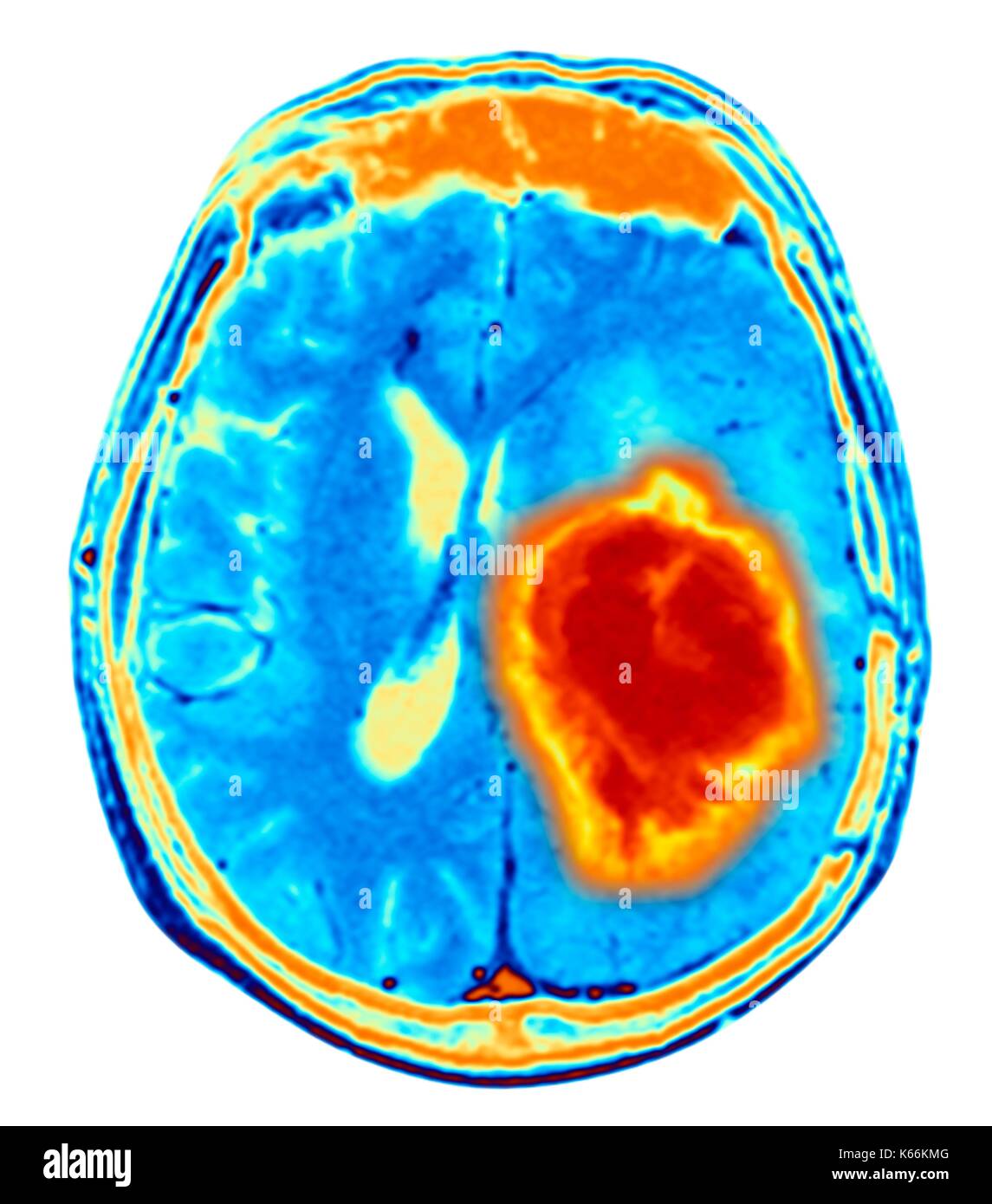 Brain tumour. Coloured Magnetic Resonance Imaging (MRI) scan of an axial section through the brain showing a metastatic tumour. At bottom left is the tumour (red-yellow) This tumour occurs within one cerebral hemisphere; the other hemisphere is at right. The eyeballs - not visible -are at top. Metastatic cancer is a secondary disease spread from cancer elsewhere in the body. Metastatic brain tumours are malignant. Typically they cause brain compression and nerve damage Stock Photo