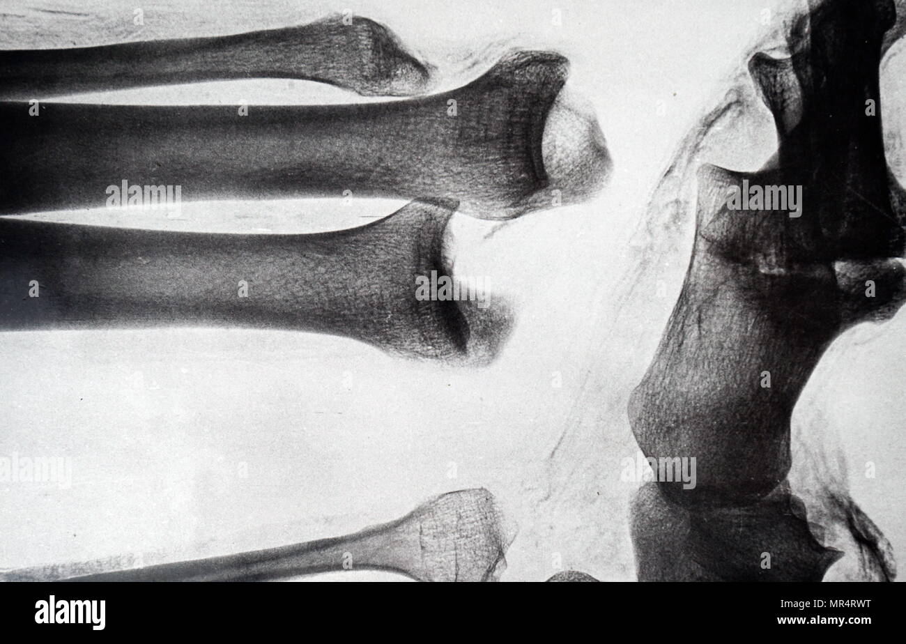 X-ray imaging of the leg of an Egyptian mummy. Dated 19th century Stock Photo