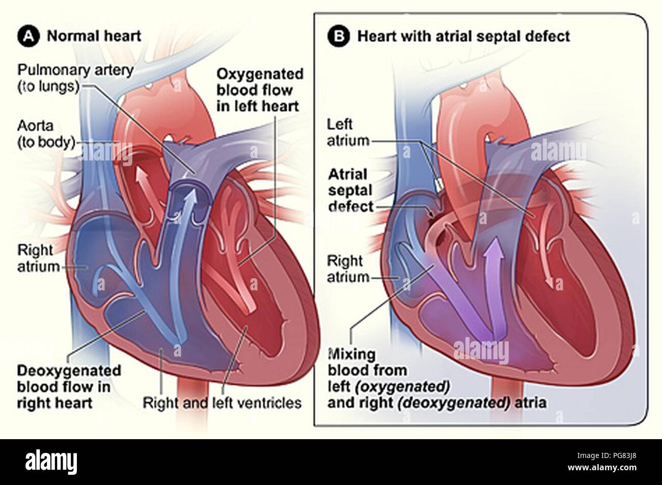 Atrial septal defect Stock Photo - Alamy