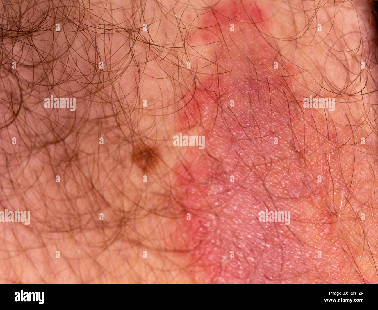 Fungal skin infection on male thigh Stock Photo