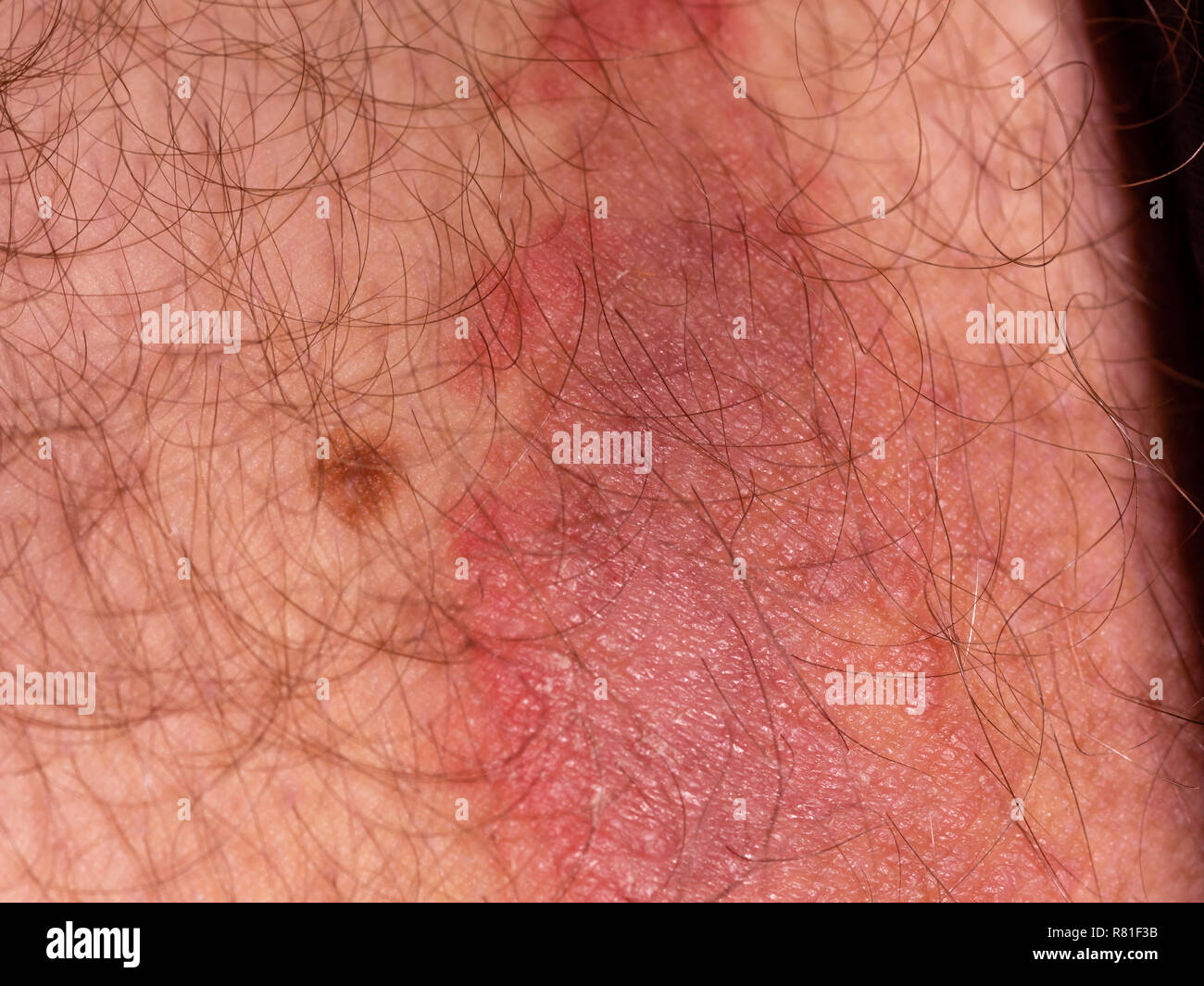 Fungal skin infection on male thigh Stock Photo