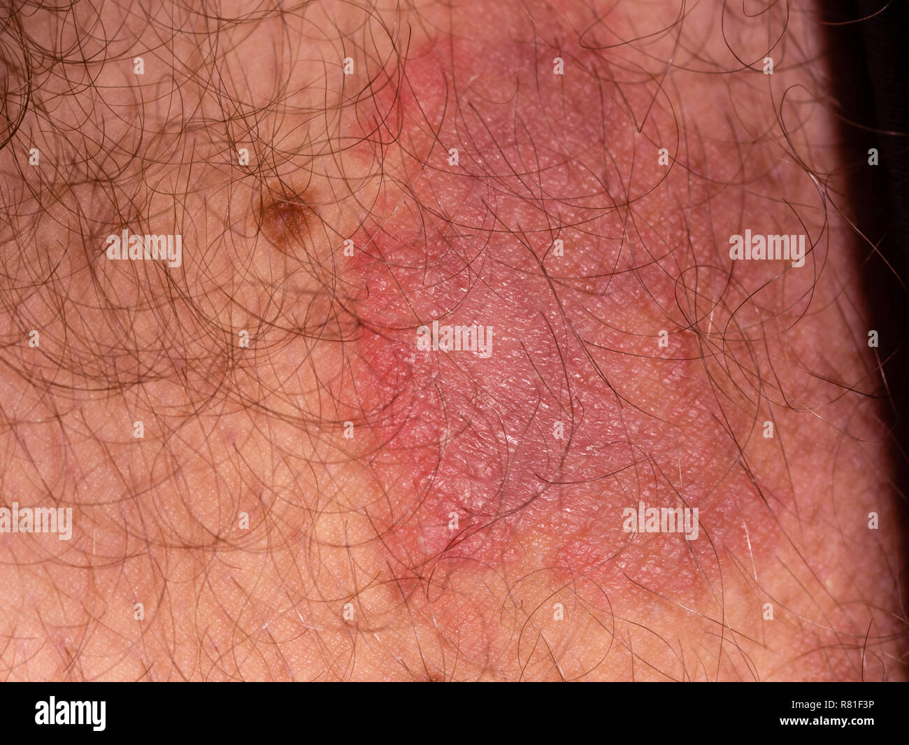 Fungal skin infection on male thigh Stock Photo