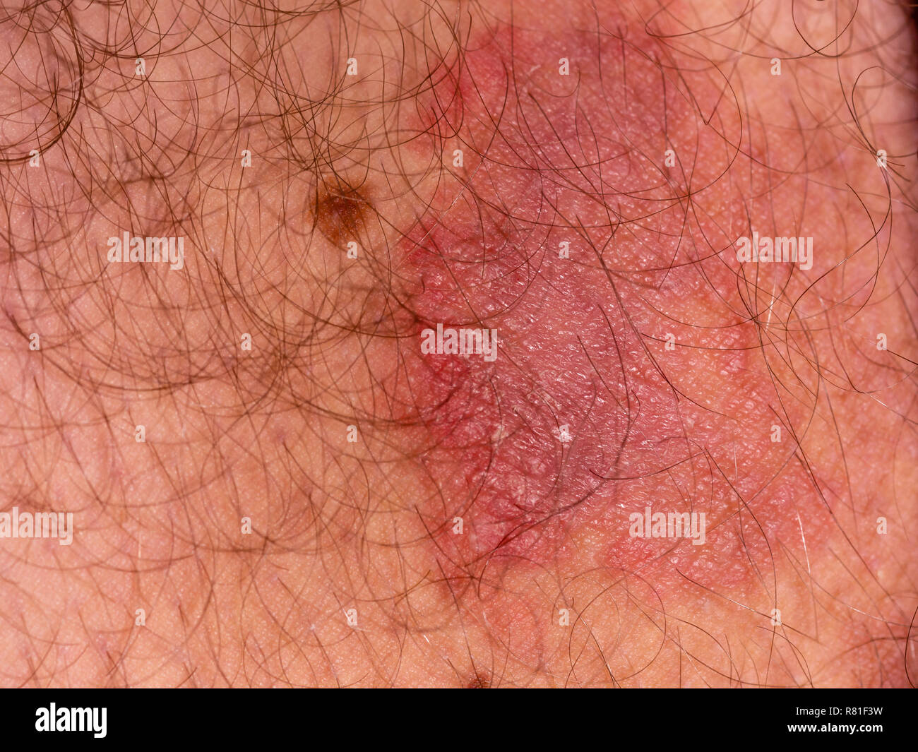 Fungal skin infection on male thigh Stock Photo