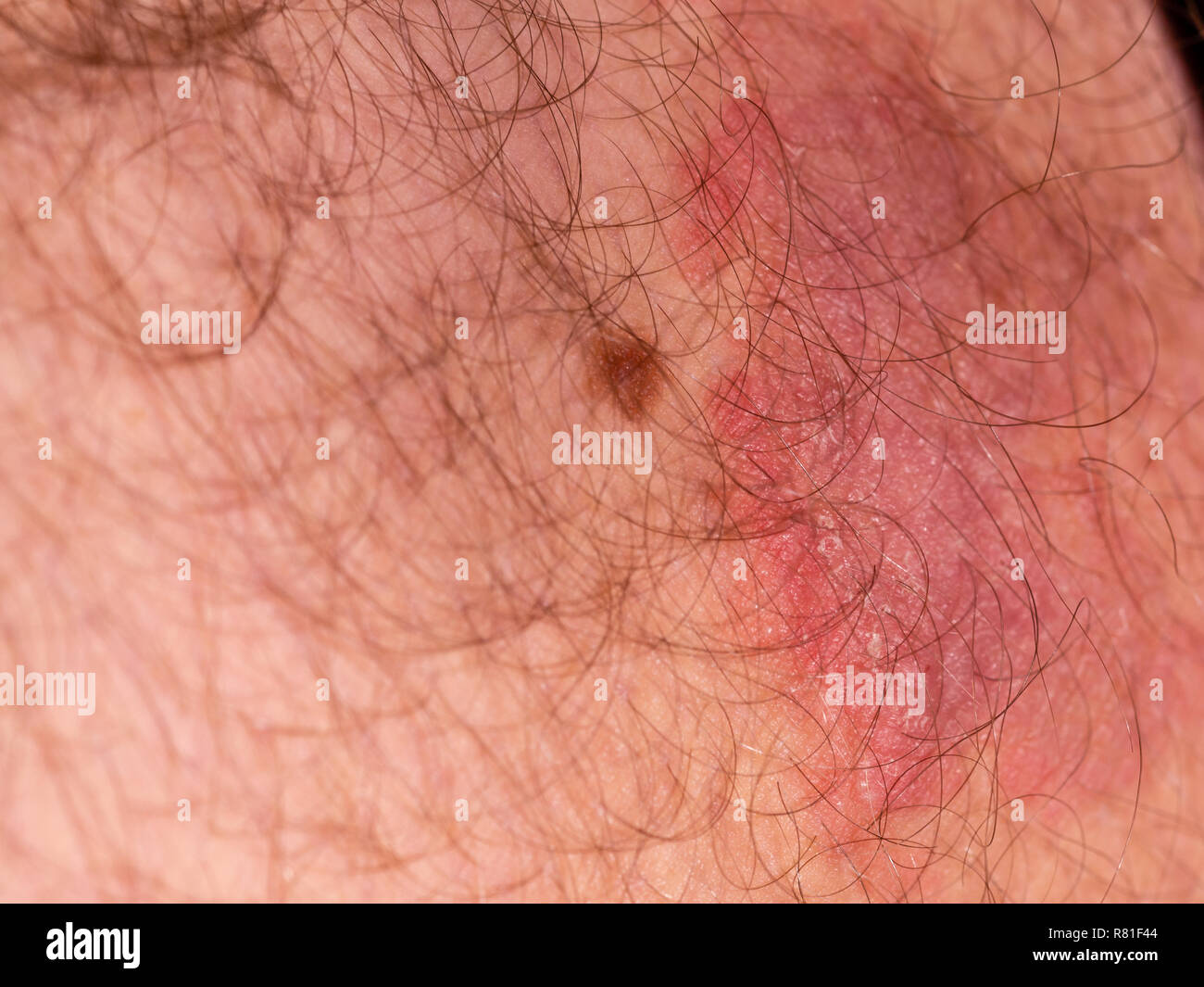 Fungal skin infection on male thigh Stock Photo