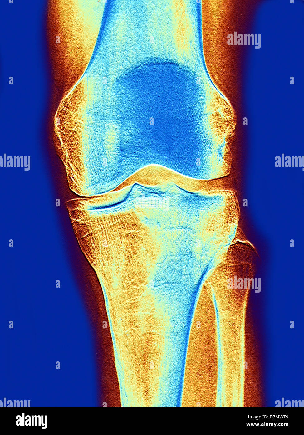 Knie Gelenk, x-ray Stockfoto