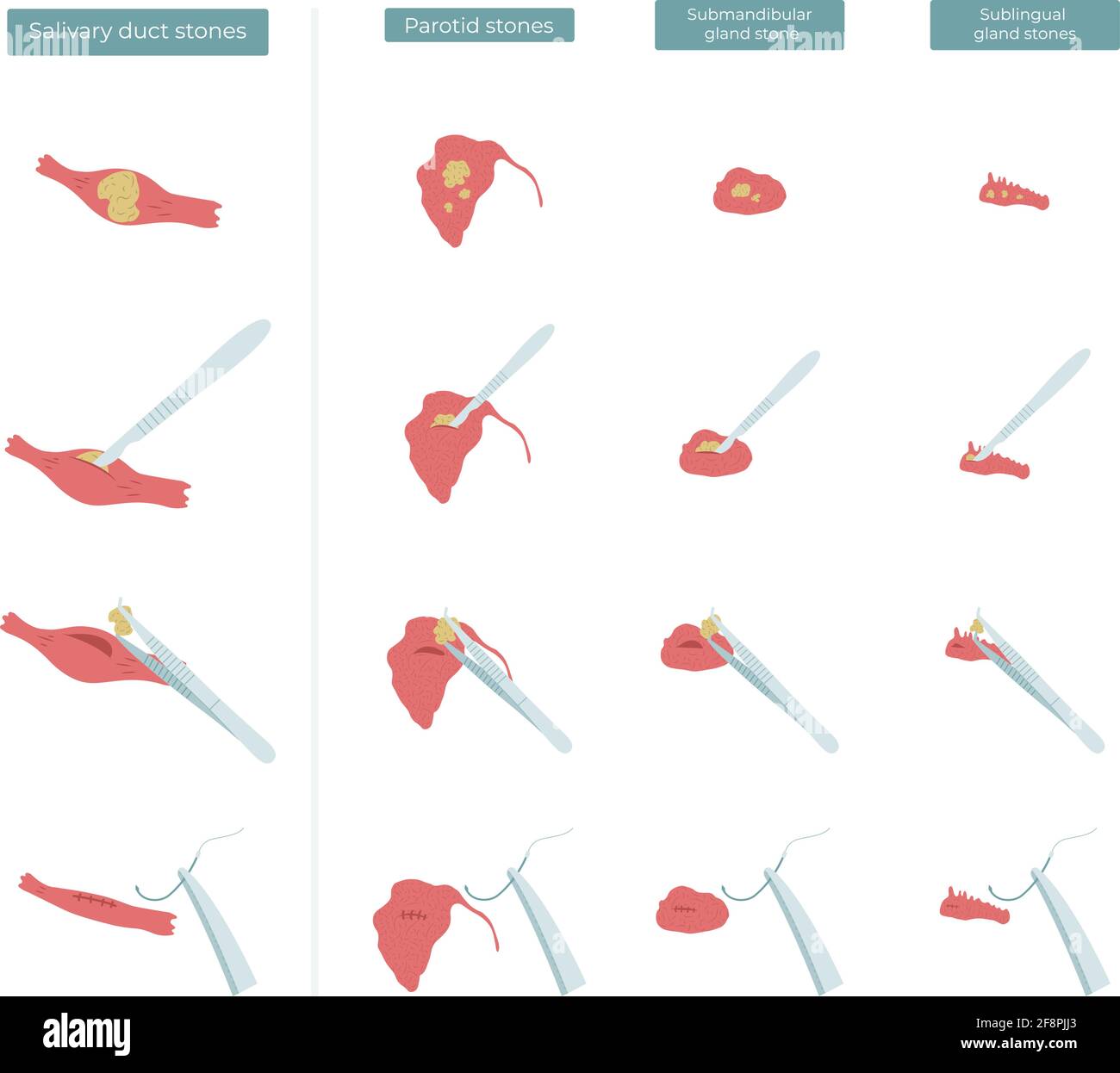 Illustrazione piatta vettoriale dell'intervento chirurgico per rimuovere le pietre dalle ghiandole salivari parotide, submandibolari e sublinguali. Illustrazione Vettoriale