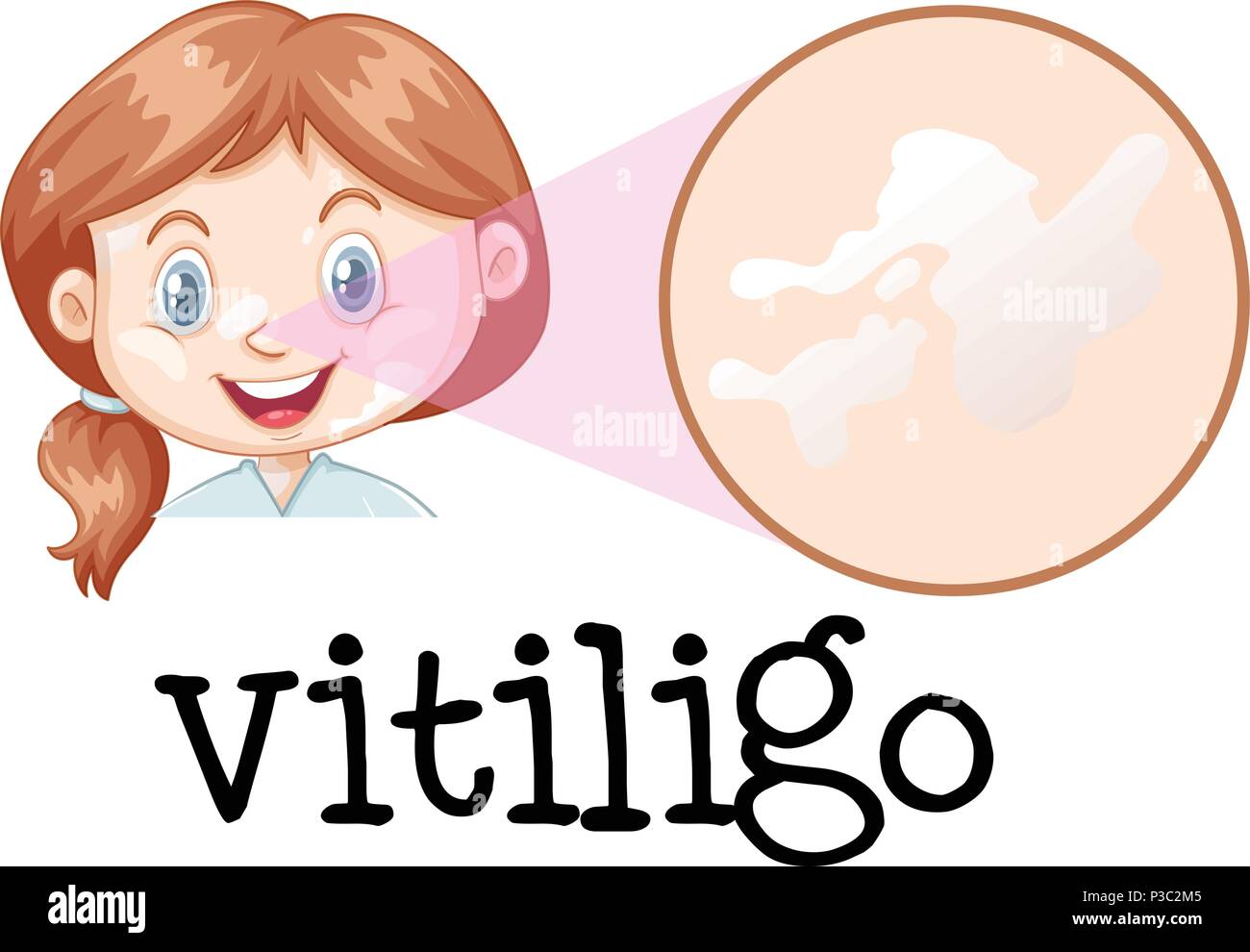 Una ragazza faccia con la vitiligine illustrazione Illustrazione Vettoriale