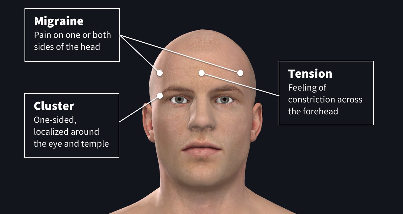 The facts about headaches