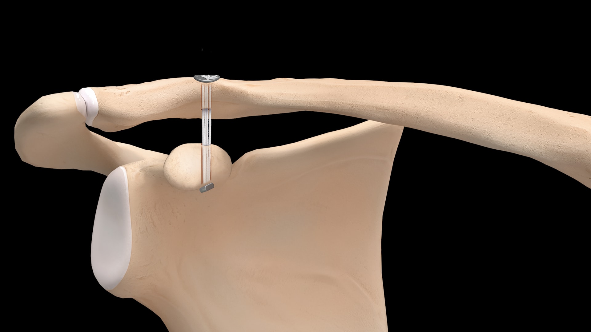 Knotless Acromioclavicular Repair