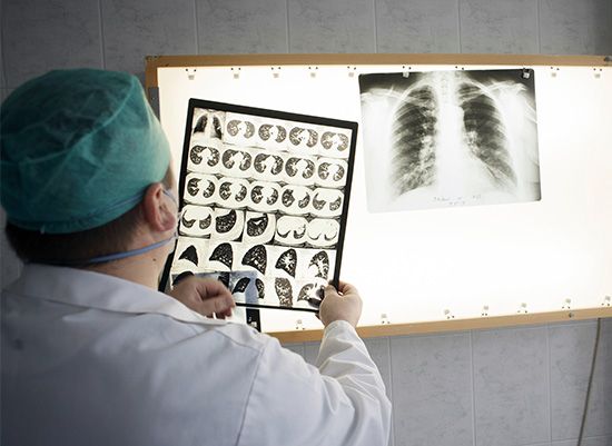 X-rays of patients infected with tuberculosis