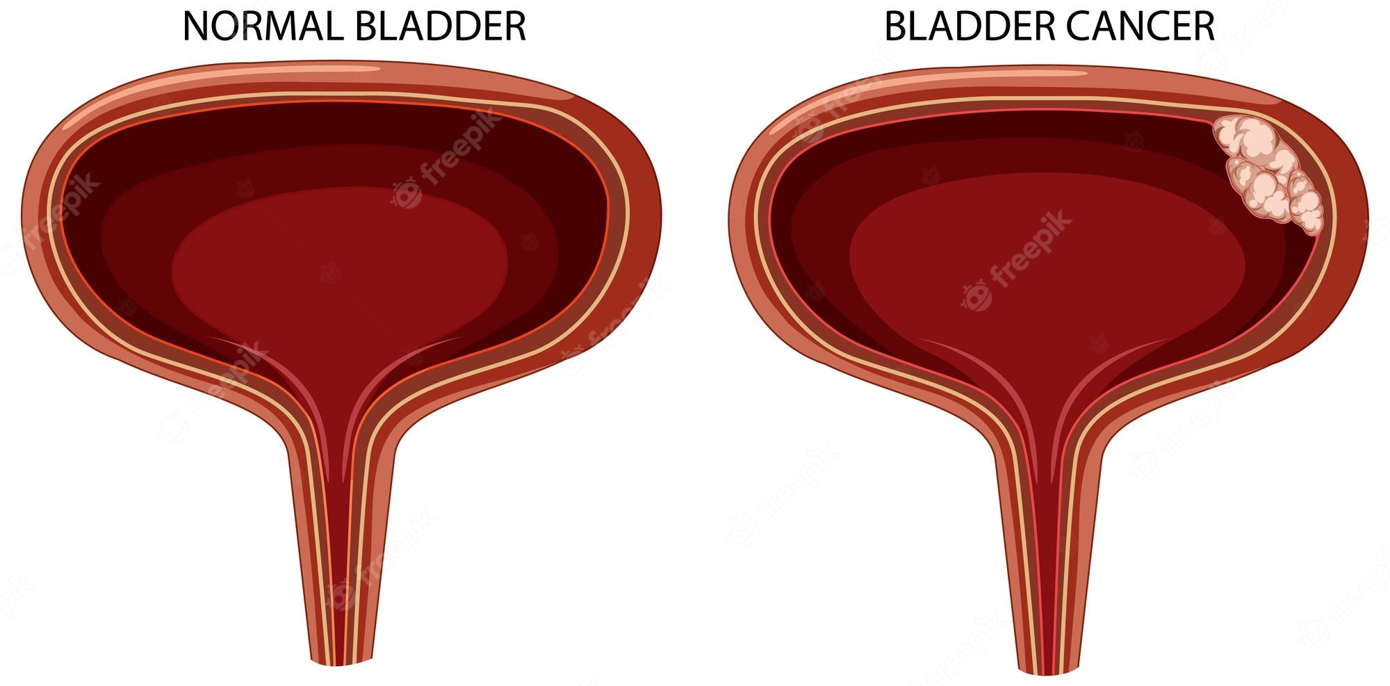 Bladder Cancer Cancer CLIPART png Sublimation - Movie Design Bundles ...