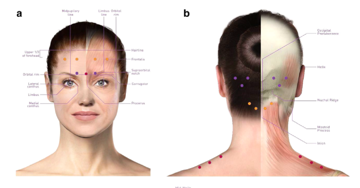 Botox For Migraines.