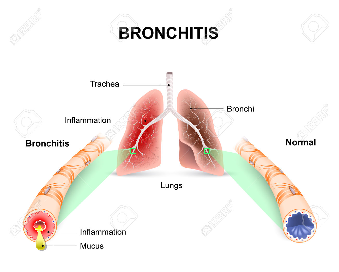 Bronchitis. Lungs And Bronchial Tubes. Normal Bronchial Tube.