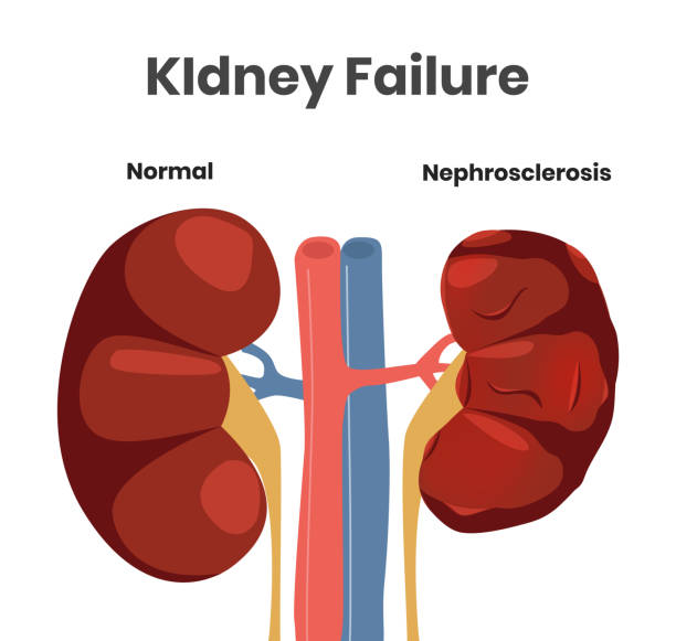 55 Kidney Failure Clip Art, Vector Graphics and Illustrations.