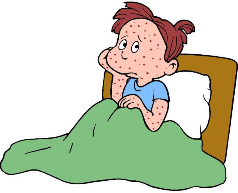 Shingles Rash Clip Art.