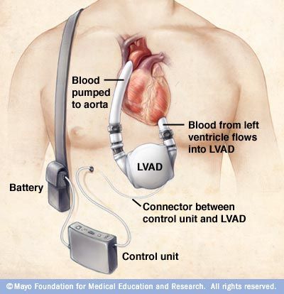 Left Ventricular Assist Device On Clip Art.