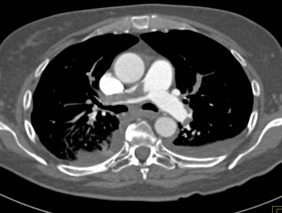 case study of patient with pulmonary embolism