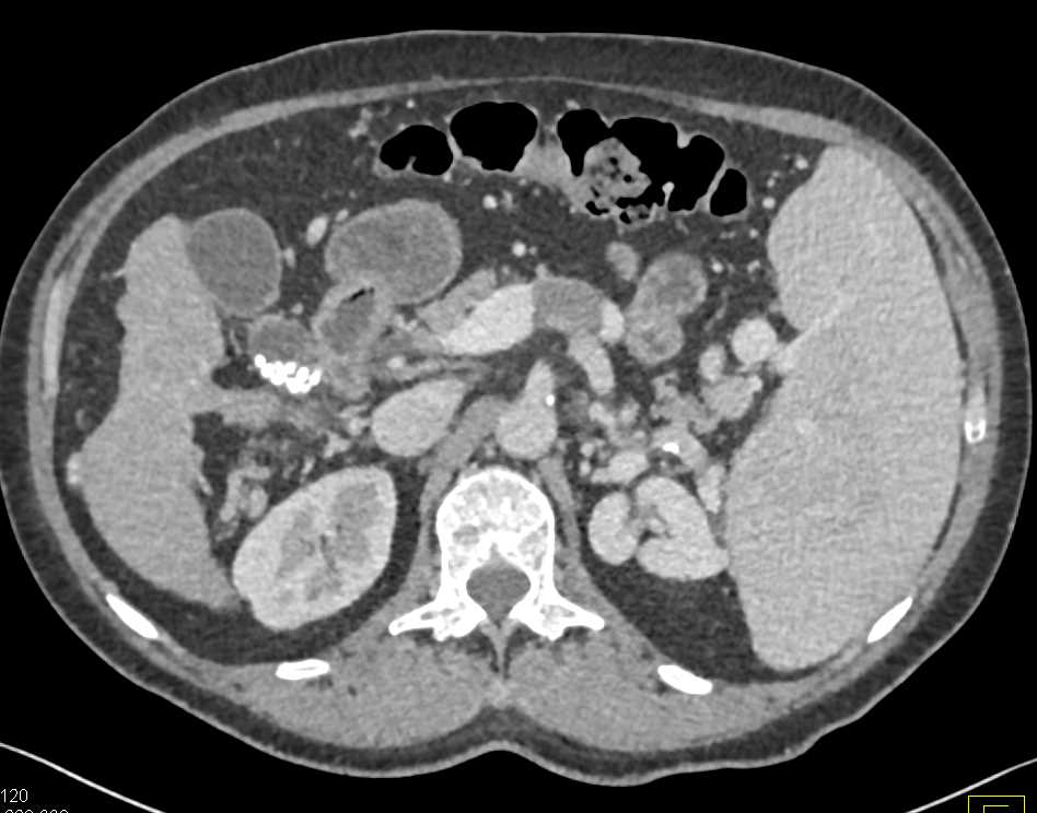 Splenic Vein Thrombosis - Spleen Case Studies - CTisus CT Scanning