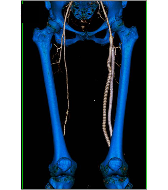 Left Superficial Femoral Artery (SFA) to Popliteal Artery Bypass Graft ...