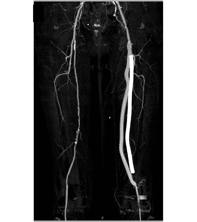 Left Superficial Femoral Artery (SFA) to Popliteal Artery Bypass Graft ...