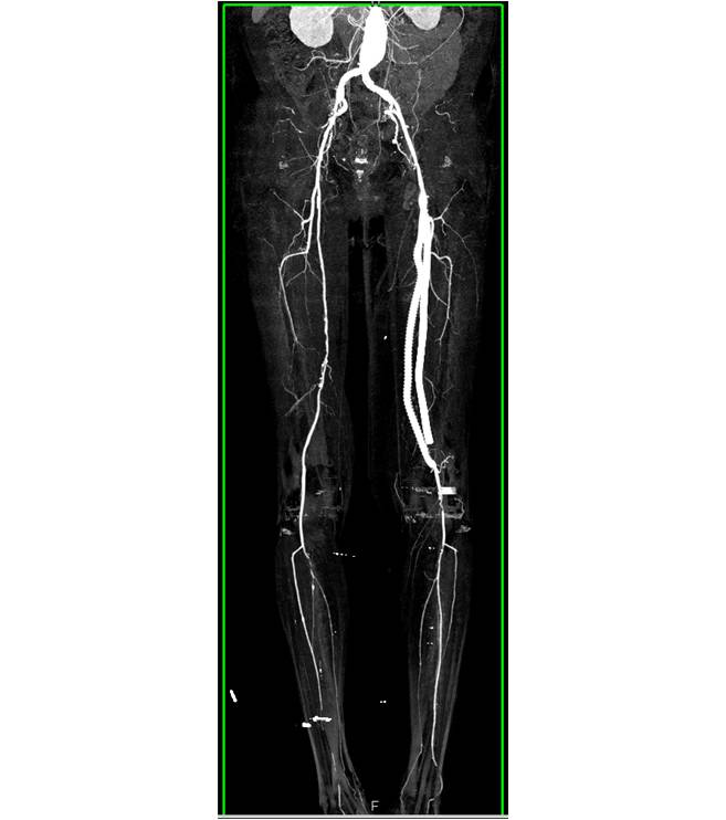 Left Superficial Femoral Artery (SFA) to Popliteal Artery Bypass Graft ...