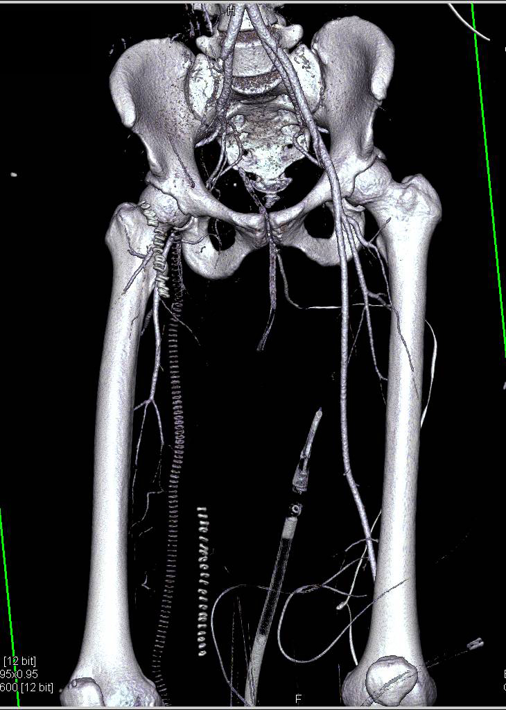 CTA With Occluded Superficial Femoral Artery, 49% OFF