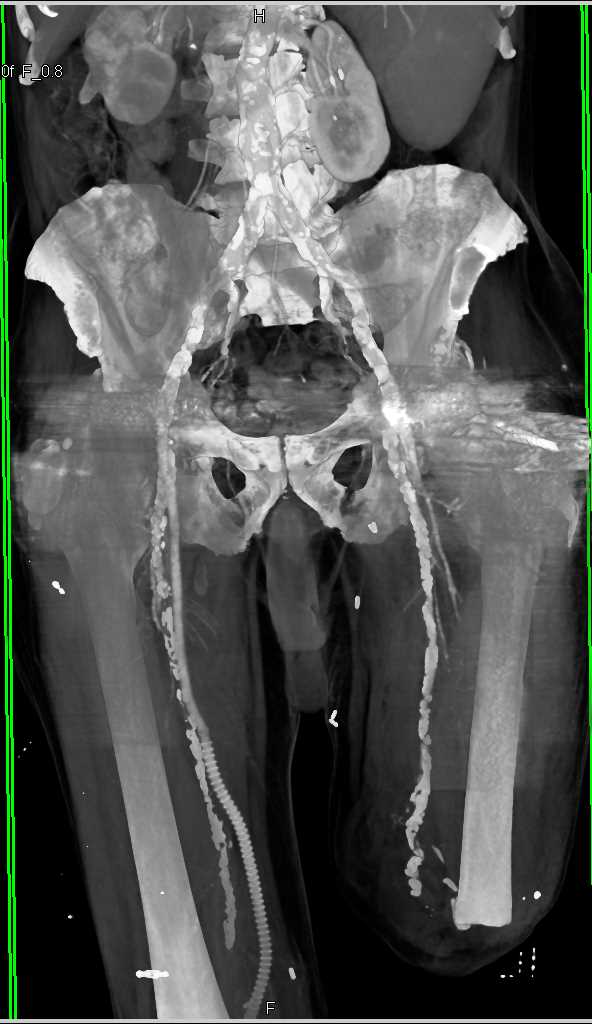 Femoral-Popliteal Bypass Grafts - Vascular Case Studies - CTisus CT ...