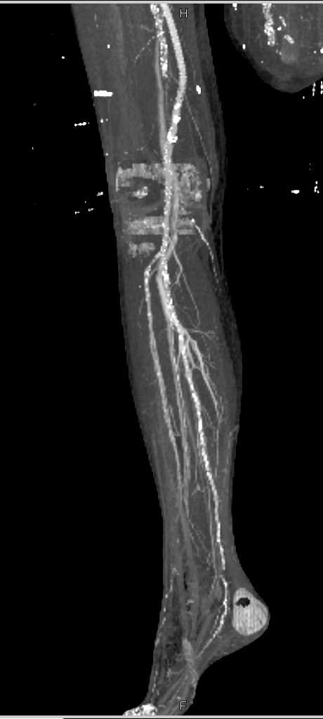 Femoral-Popliteal Bypass Grafts - Vascular Case Studies - CTisus CT ...