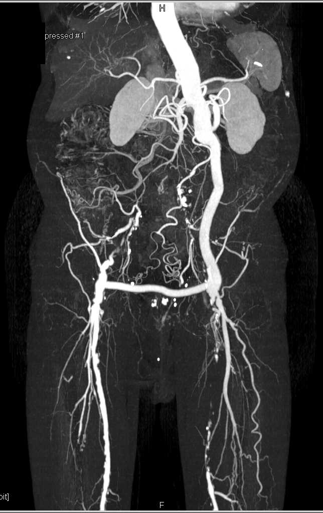 Femoral Artery Occlusion