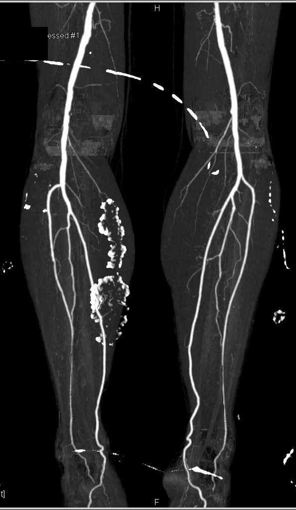 Fem-Fem Bypass Graft with Left Superficial Femoral Artery (SFA ...