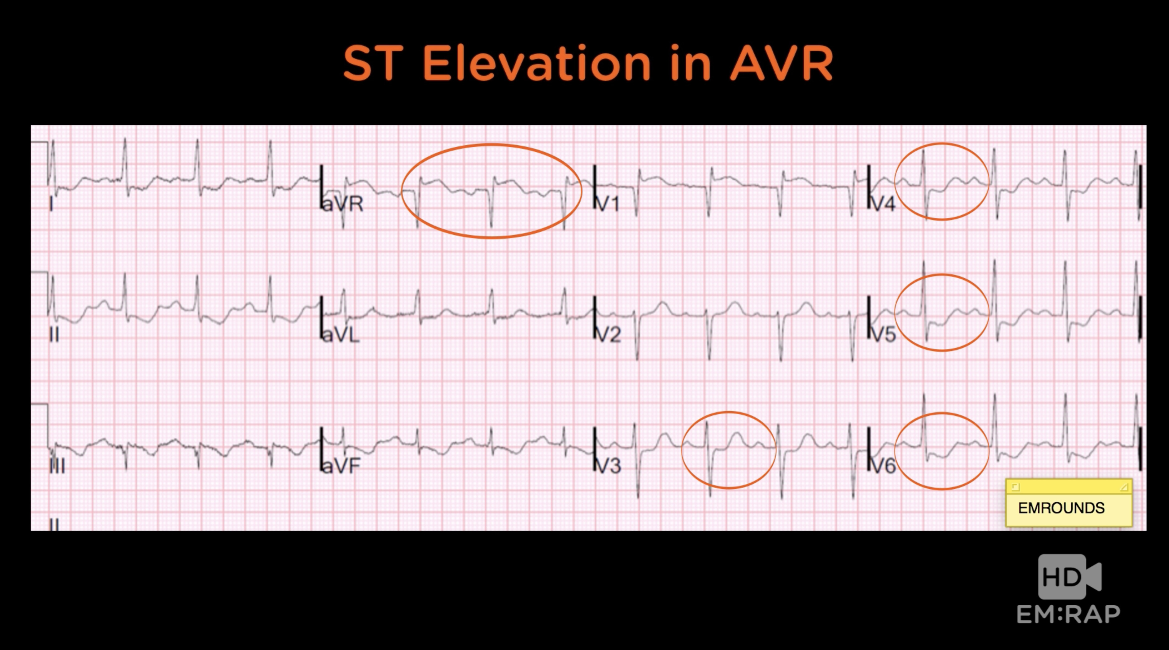 Pulmonary Embolism Ecg