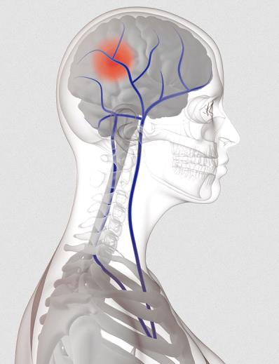 Neuromuscular Electrostimulation Device for VTE Prevention