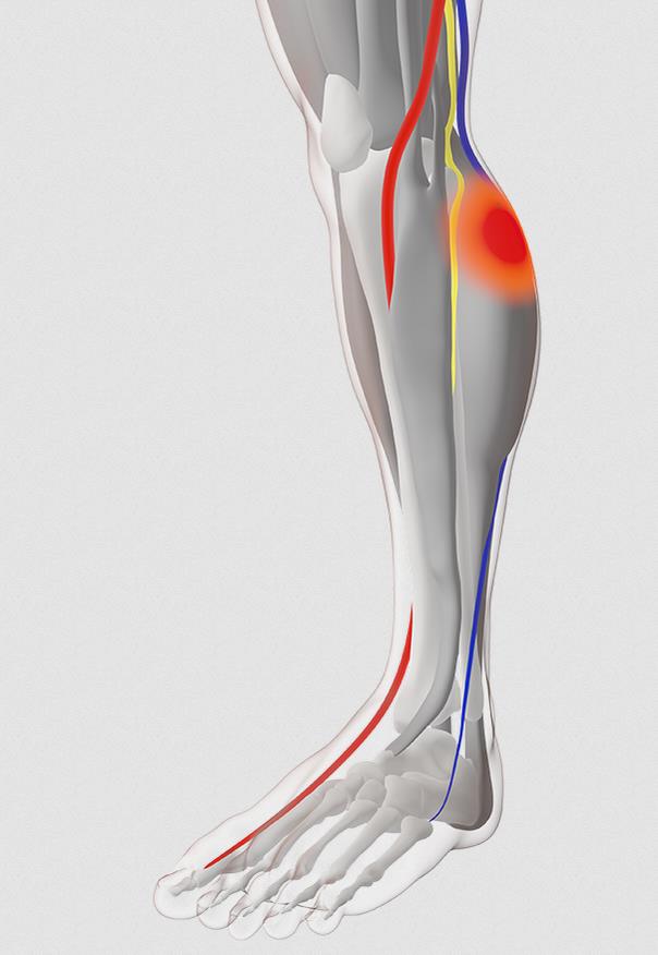 Neuromuscular Electrostimulation Device for VTE Prevention