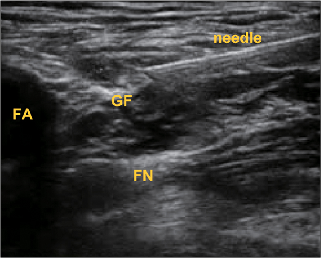 Ultrasound-guided femoral nerve, femoral branch of genitofemoral nerve ...