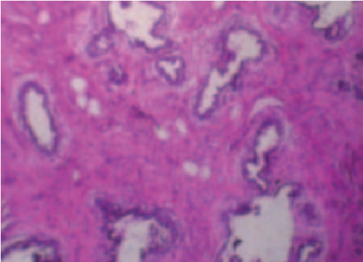 Figure 1 from Giant Breast Hypertrophy in Juvenile: A Rare Case ...