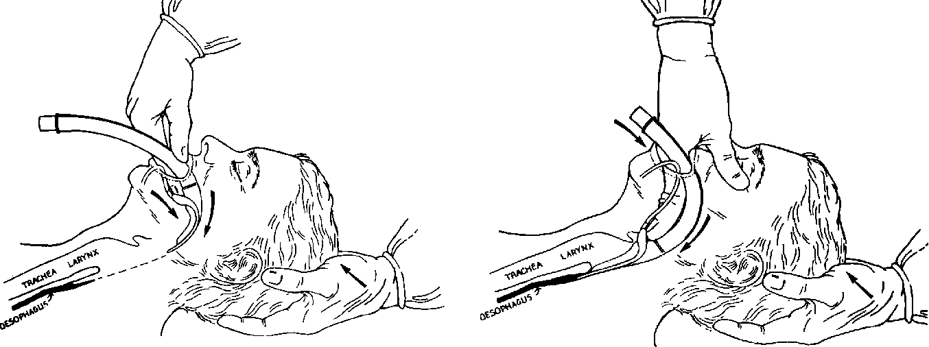 Figure 3-12 from Airway-Management Adjuncts PLACEMENT OF AIRWAY DEVICES ...