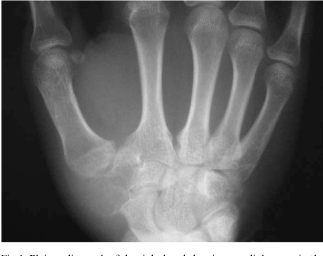 Unusual Arterial Anatomy in a Case of Index Finger Pollicization ...