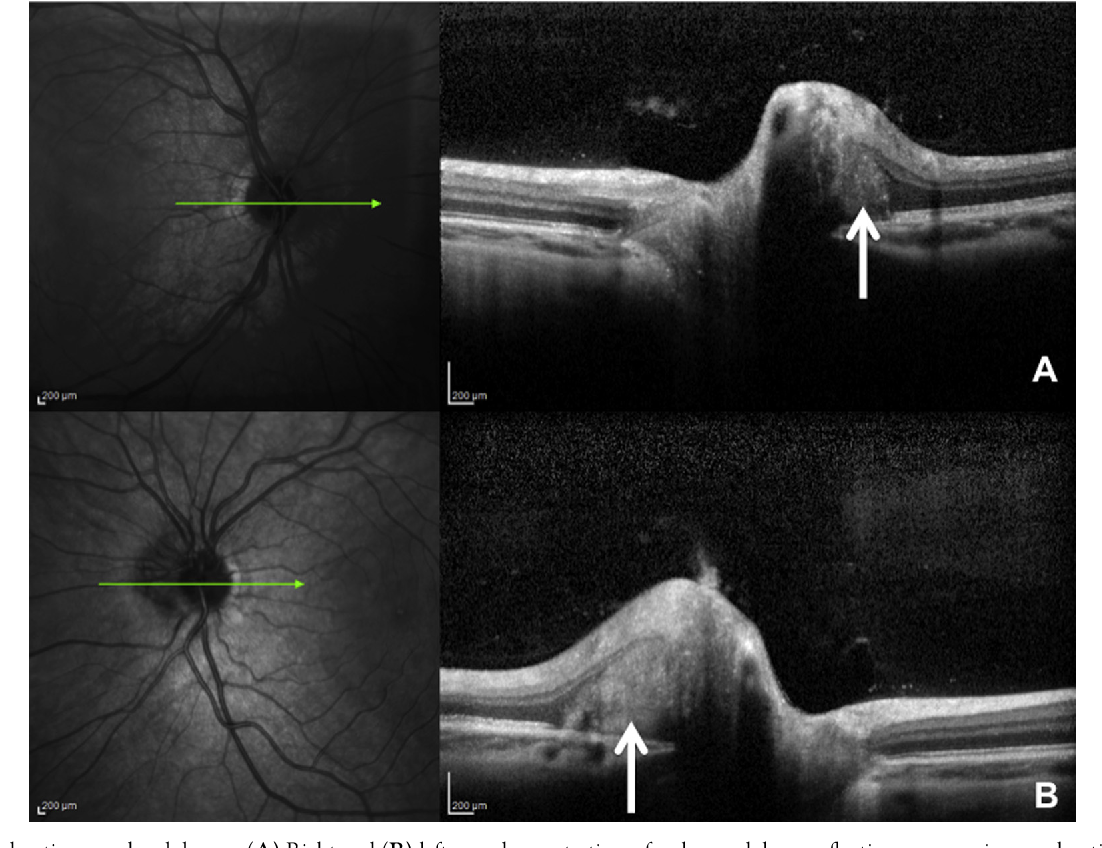 Figure 2 from Differentiating mild papilledema and buried optic nerve ...