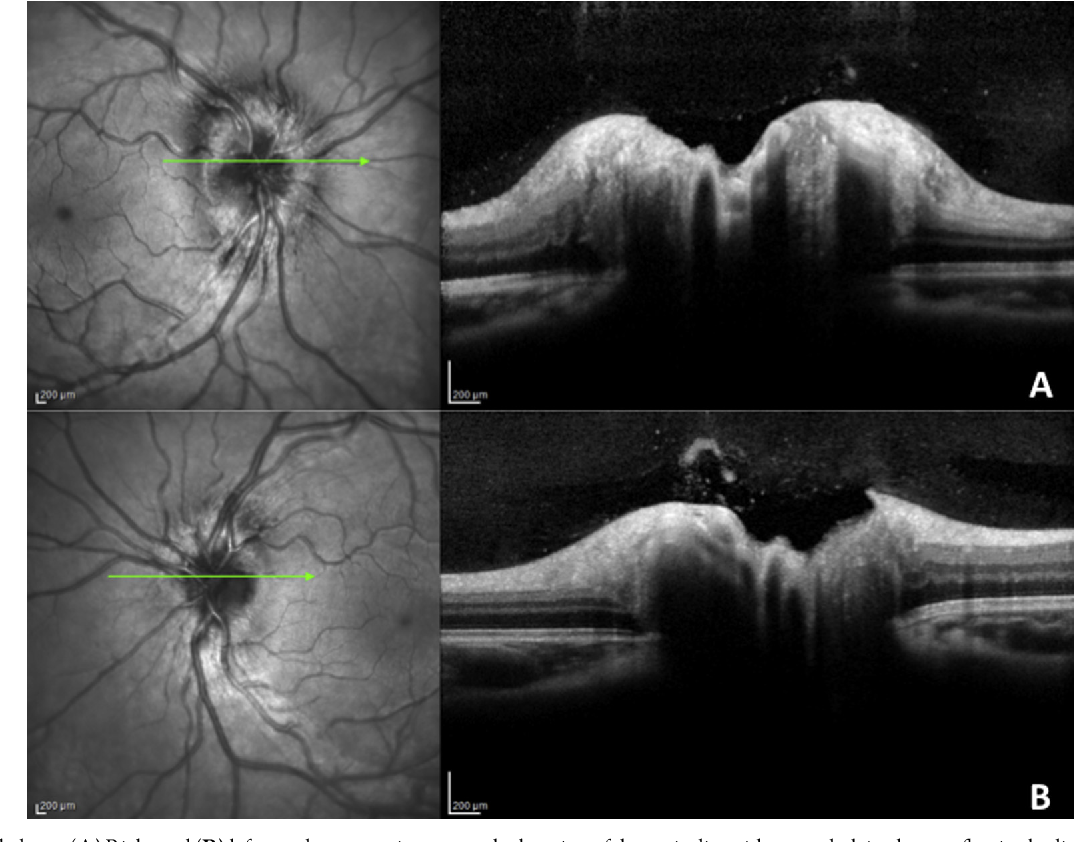 Figure 1 from Differentiating mild papilledema and buried optic nerve ...